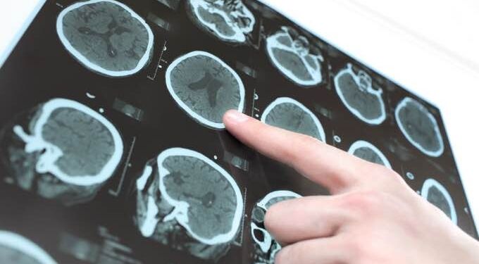 A Radically New Understanding of Alzheimer’s Disease Causes and Cures
