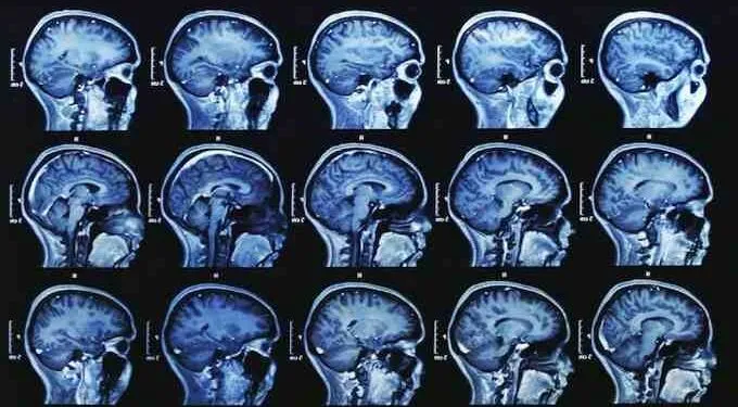 Read the Shocking Conclusions from 28 Medical Studies Linking Fluoride to Lower IQ in Children
