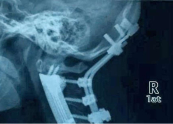 Surgeons In China Replace Six Neck Bones With 3D-Printed Spine
