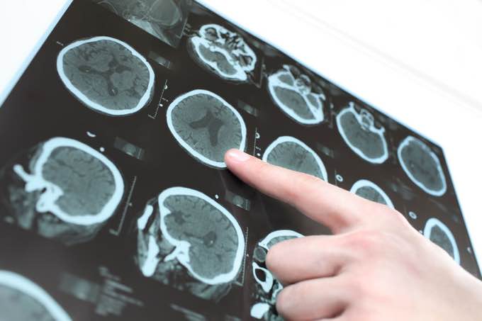 A Radically New Understanding of Alzheimer’s Disease Causes and Cures