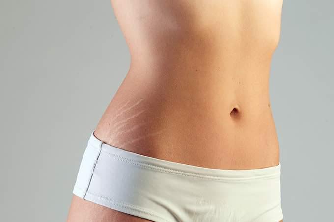 How Do Stretch Marks Impact a Woman’s Life?