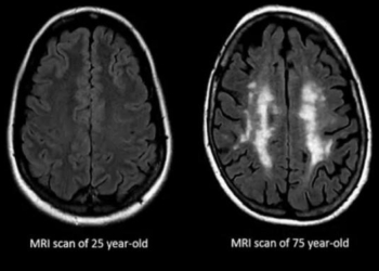 Scientists May Have Just Found a Way to Prevent the Brain From Aging