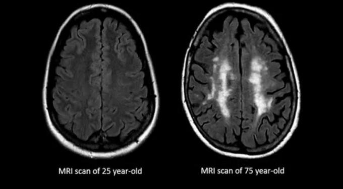 Scientists May Have Just Found a Way to Prevent the Brain From Aging