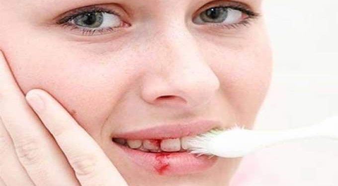 Home Remedies for Swollen and Bleeding Gums!