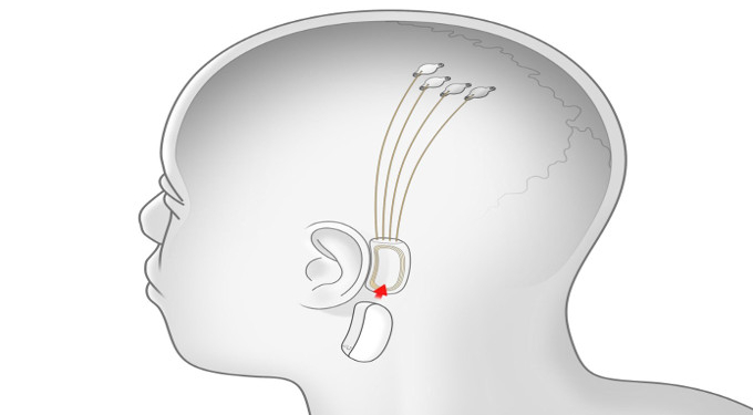 Elon Musk’s Neuralink Looks to Begin Outfitting Human Brains With Faster Input and Output Starting Next Year