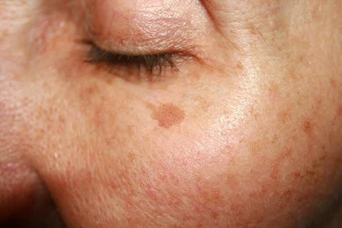 Pigmentation Removal in Singapore – What You Have To Know