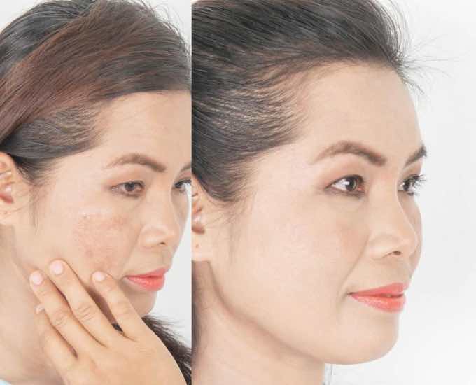 Pigmentation Removal in Singapore – What You Have To Know