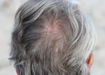 Scientists Finally Figure Out How Stress Turns Hair Gray