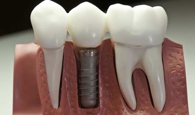 Why Advanced Technology in Dental Implants Are Good for You