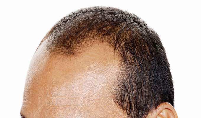 Treat Male Pattern Baldness With These Effective Methods