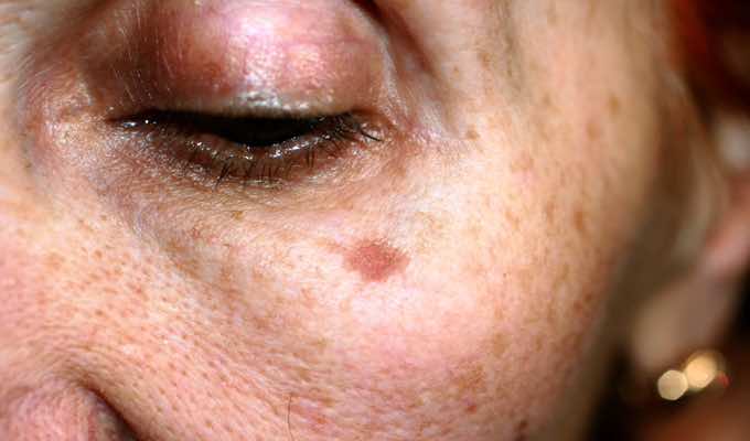 Five Common Skin Conditions & How to Treat Them