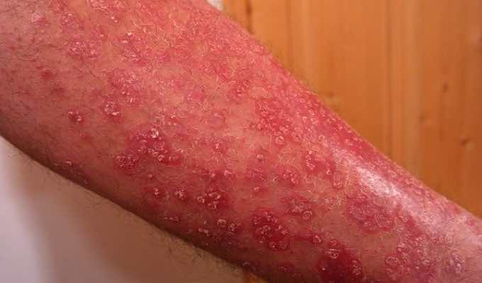 Is There a Link Between Alcohol Consumption and Psoriasis?